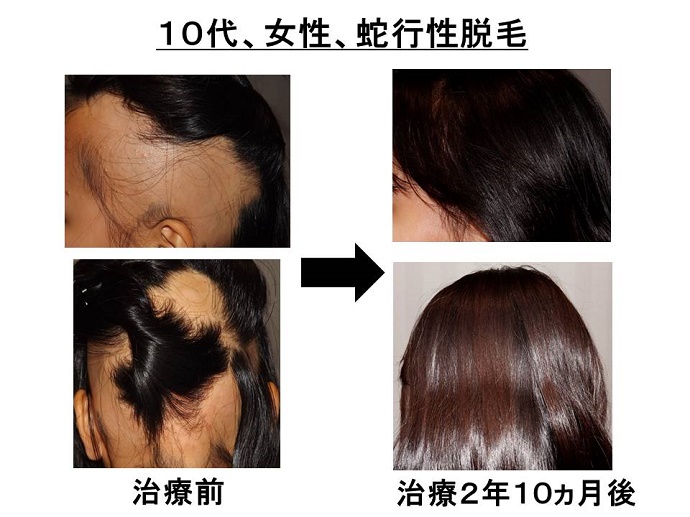 円形脱毛症　病院